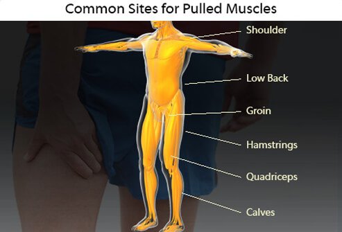 Illustration showing the areas of the body where a pulled muscle can occur.